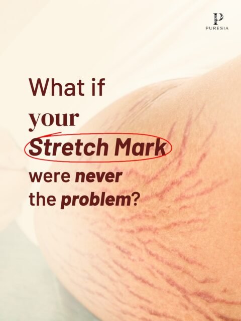Every line tells a story of strength and transformation.We often look at them as imperfections, but at PURESIA, we see them as milestones of a life beautifully lived ✨🤍 #stretchmarktreatment #puresia #healingrituals #stretchmarkoil #stretchmarksarebeautifulYour skin isn’t just a canvas; it’s a masterpiece in progress.